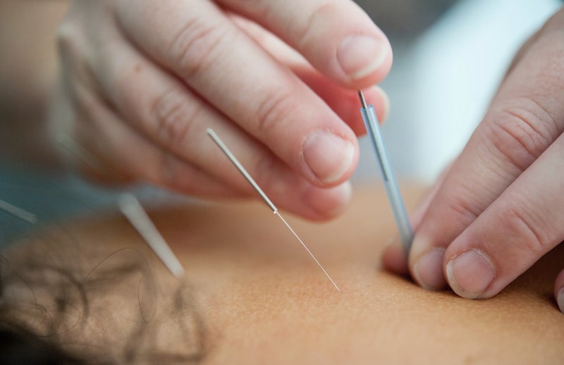 Acupunctuur behandeling